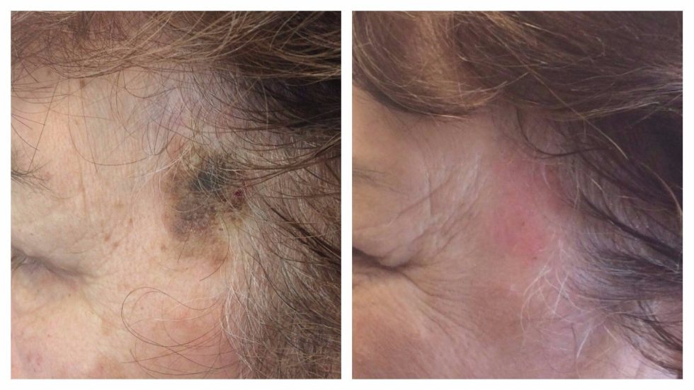 Microlaser Peel Skin Treatment Newcastle - The Mayah Clinic