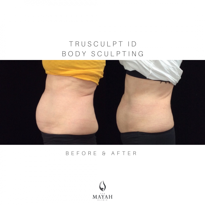 before and after trusculpt stomach
